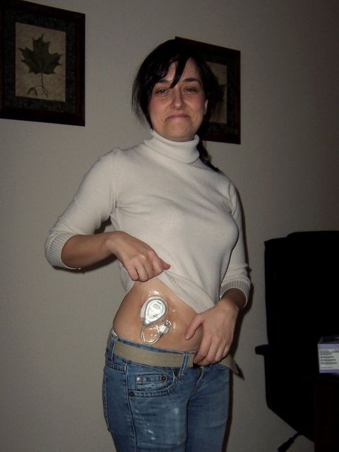Marisa en 2003 llevando un sensor ciego de glucosa de una investigación científica
